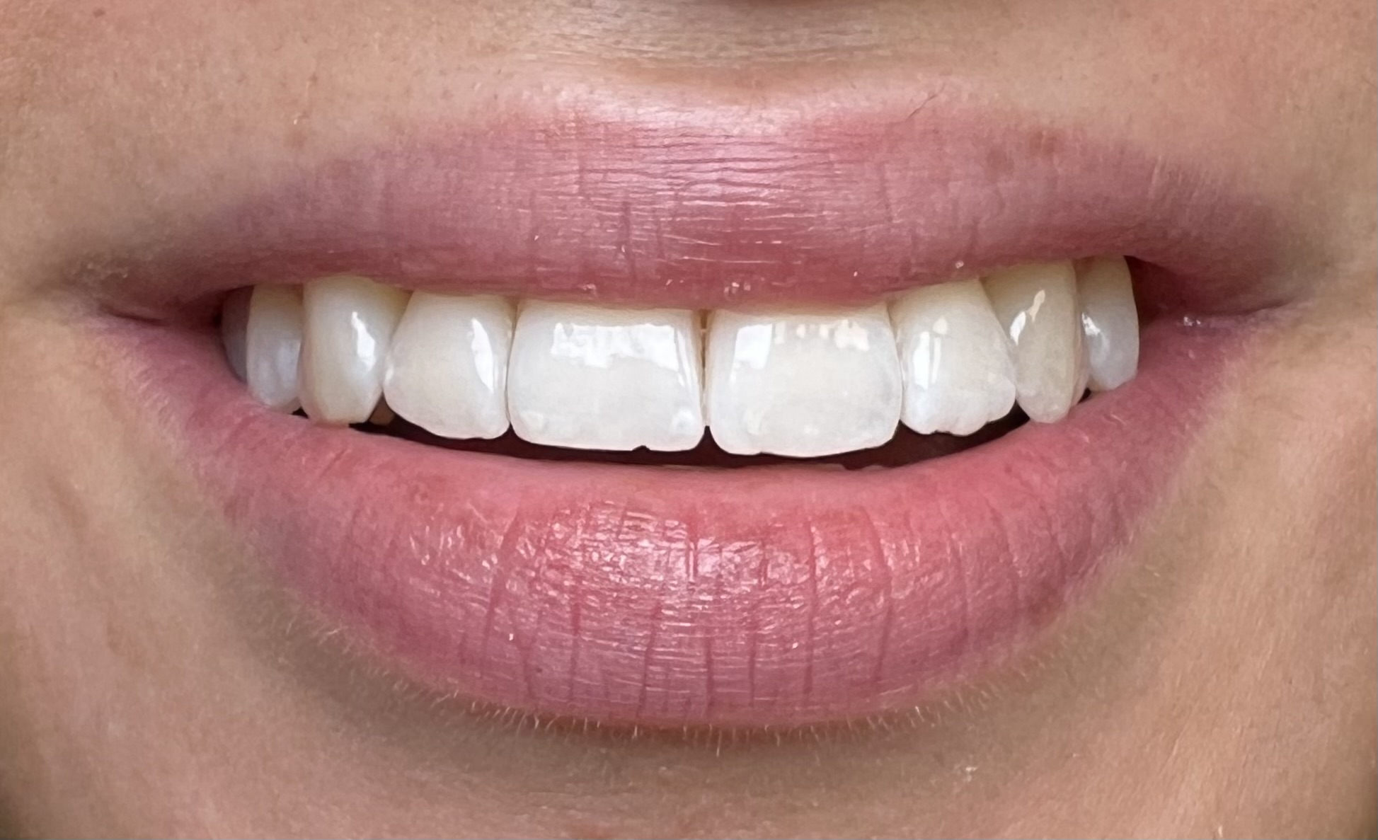 Tänder efter Invisalign-behandling