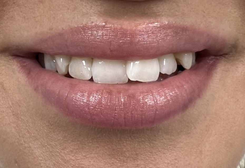Tänder före Invisalign-behandling